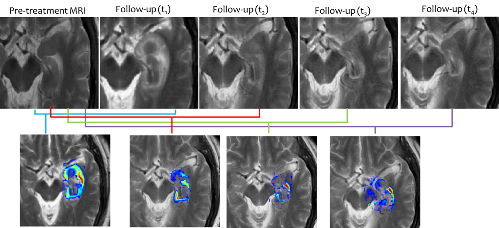 TREATMENT EVALUATION: Evaluating early response to treatment of neurological disorders